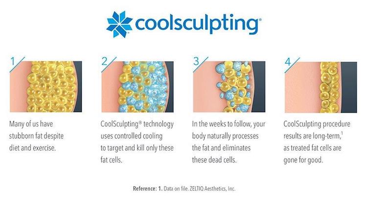 Coolsculpting steps