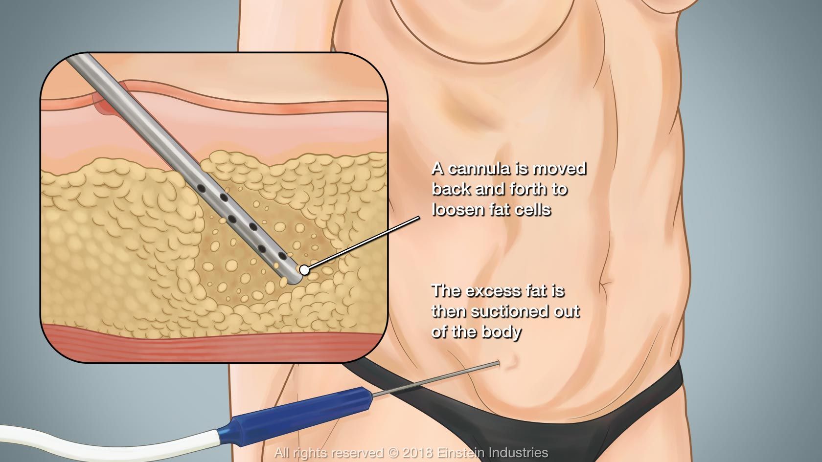 Illustration of liposuction